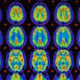 Desarrollan medicamento que frena el Alzheimer