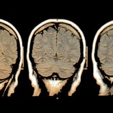 Detectan actividad en cerebros en muerte cerebral 