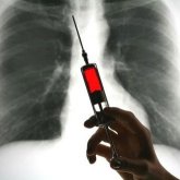 Registran vacuna contra el cáncer de pulmón