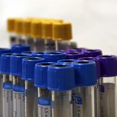 Test de sangre predice la aparición del Alzheimer